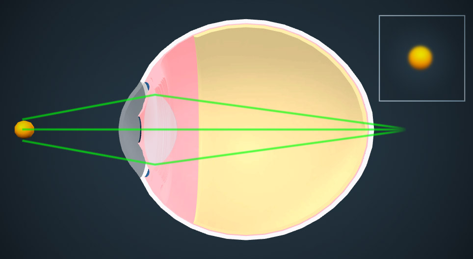 Die Korrektur von Fehlsichtigkeit