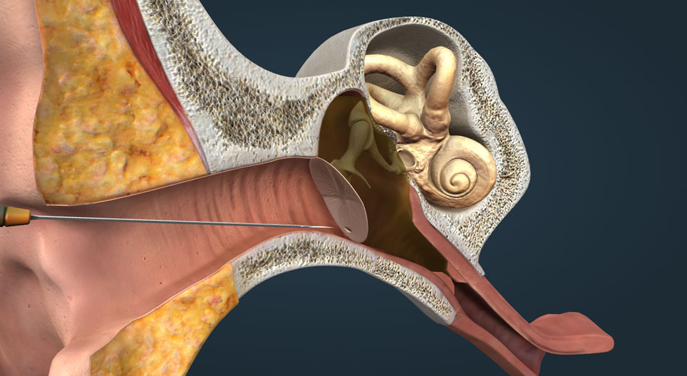 Middle ear infection, otitis media