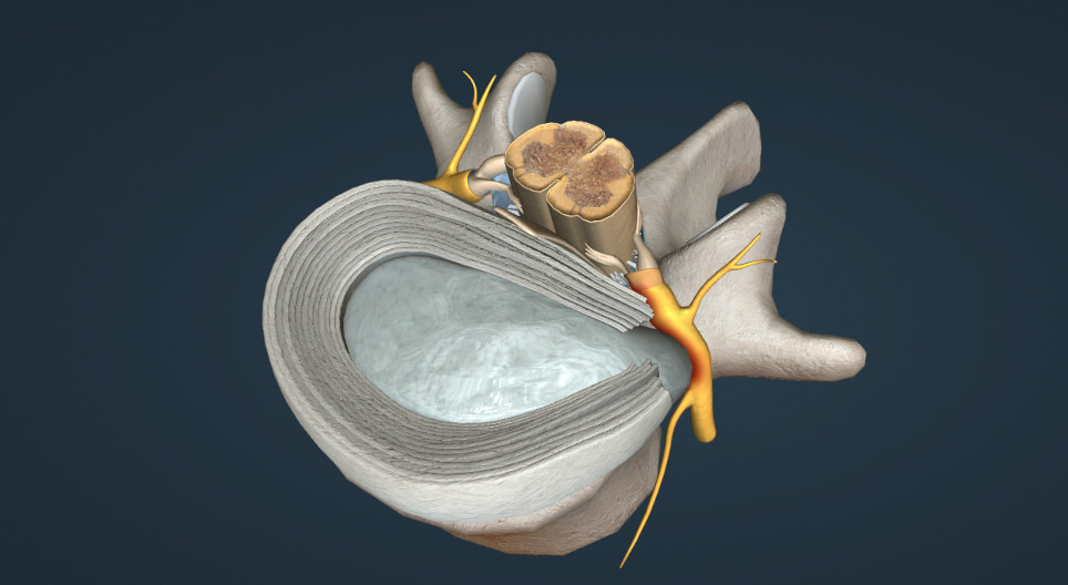 Porckorongsérv – Discus hernia