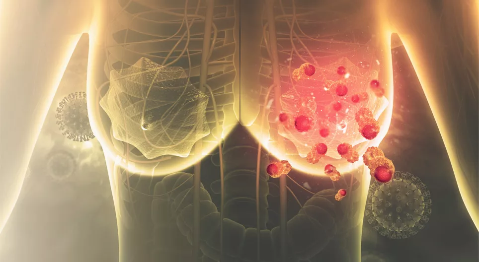 Emlődaganatos kezeléssel kapcsolatos gyakorlati fizioterápiás vonatkozások