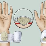 Primjena tlačnog zavoja