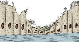 Csillós hám egy dohányzó ember légutaiból