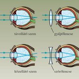 A közel- és távollátó szem hibáinak „javítása”