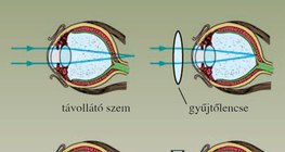 A közel- és távollátó szem hibáinak „javítása”