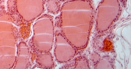 Pajzsmirigyből készült metszet