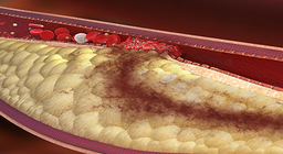 A perifériás artériás érbetegségek a fizioterápia szemszögéből