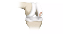 Az ízületi porc biomechanikai tulajdonságai és viselkedése