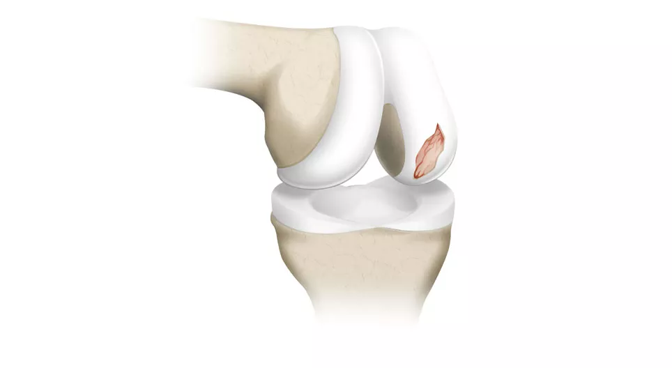 The biomechanical properties of articular cartilage