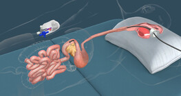 Az ERCP vizsgálat