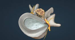 Porckorongsérv – Discus hernia