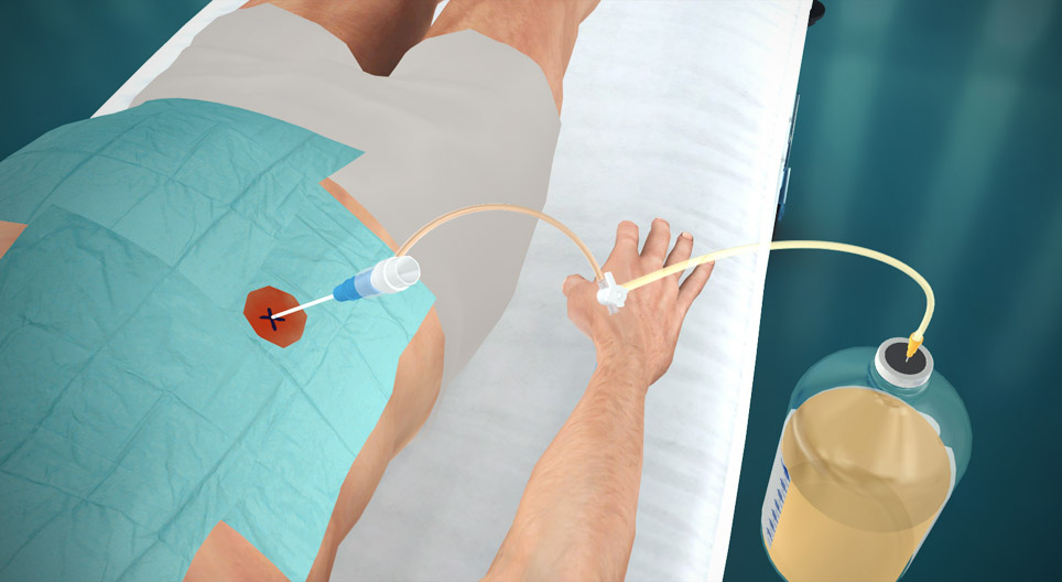 Paracentesis