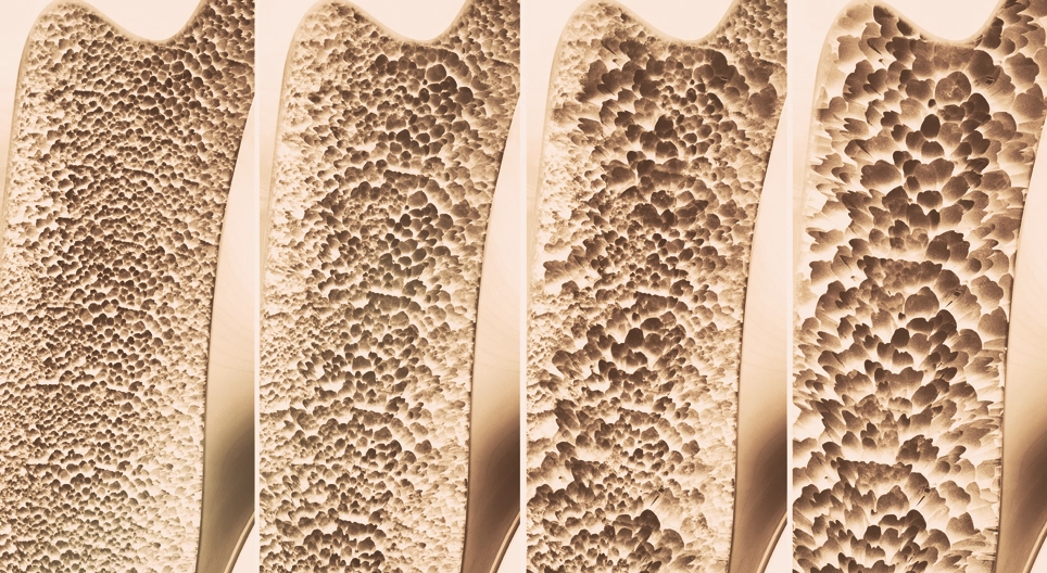 Csontritkulás (Osteoporosis)